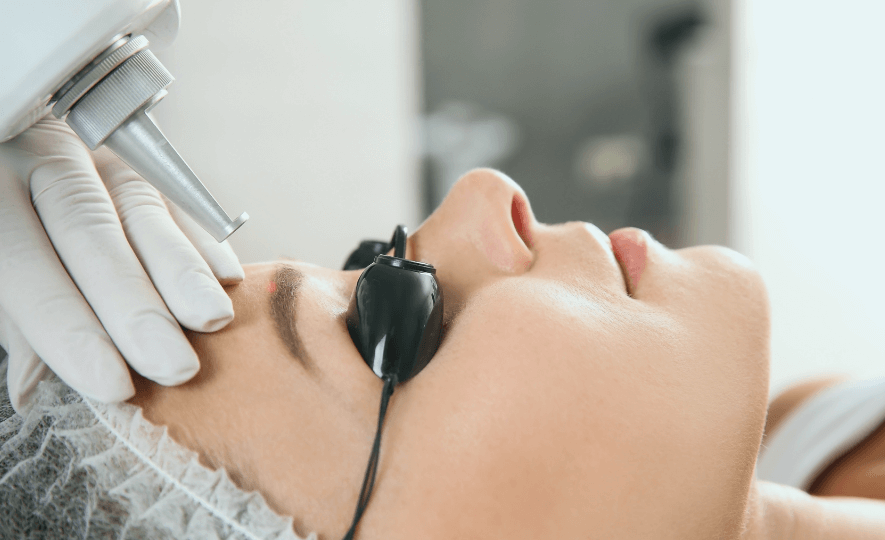 kestopigmentoinnin poisto