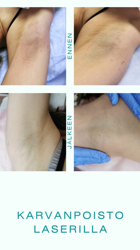 karvanpoisto laserilla