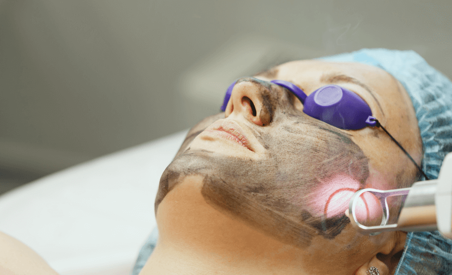 Carbon-kuorinta laserilla