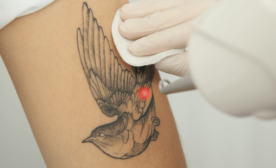 Tatuoinnin poisto laserilla