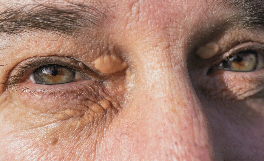 Ksantelasmojen poisto