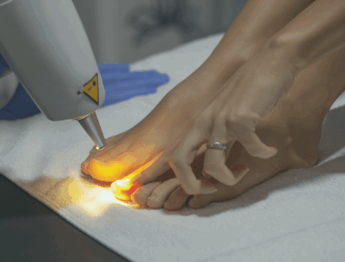 kynsisienen laserhoito