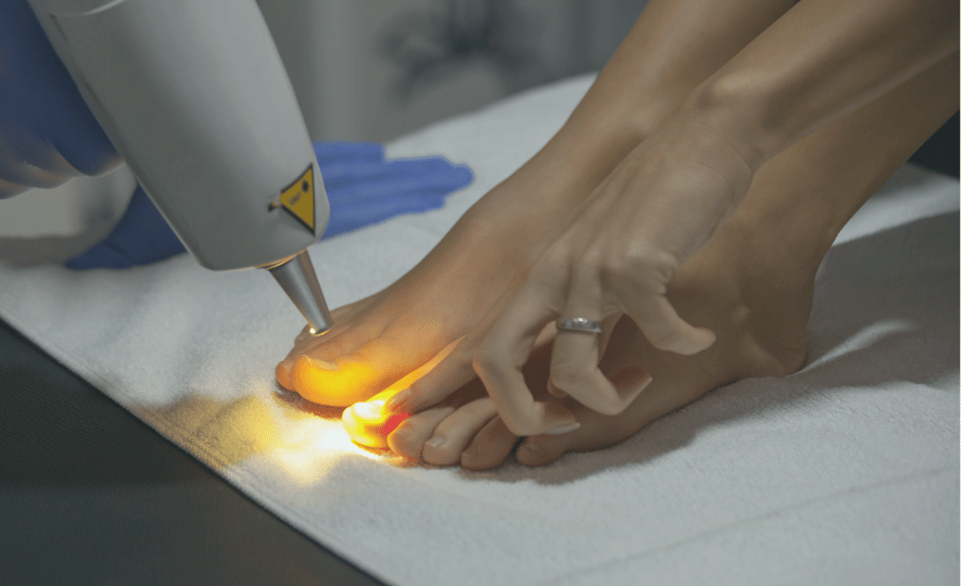 kynsisienen laserhoito